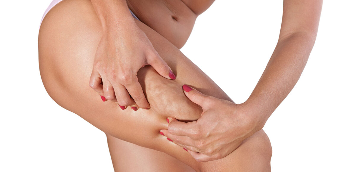 photo de femme montrant sa cellulite