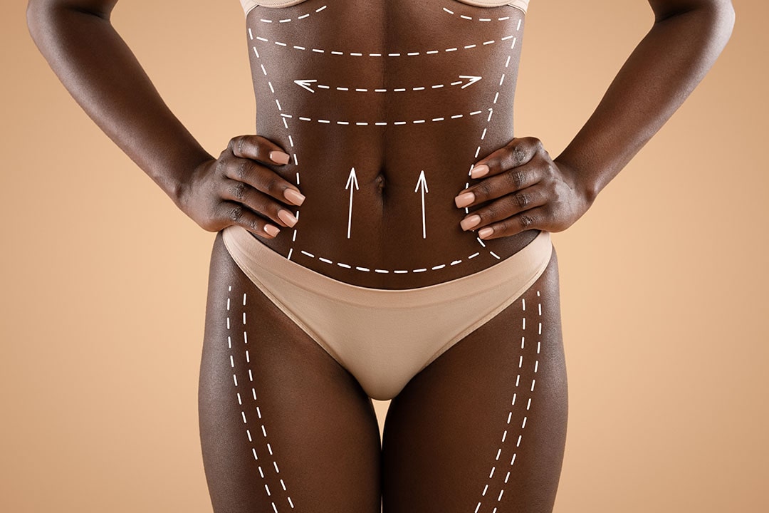 schéma du bodycontouring pour améliorer la silhouette et faire disparaitre la culotte de cheval